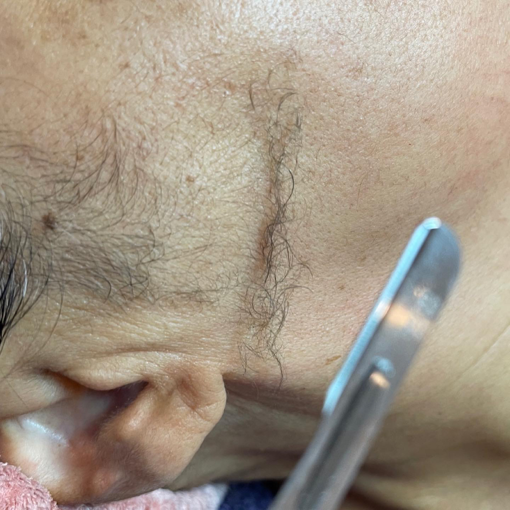 Dermaplaning Facial