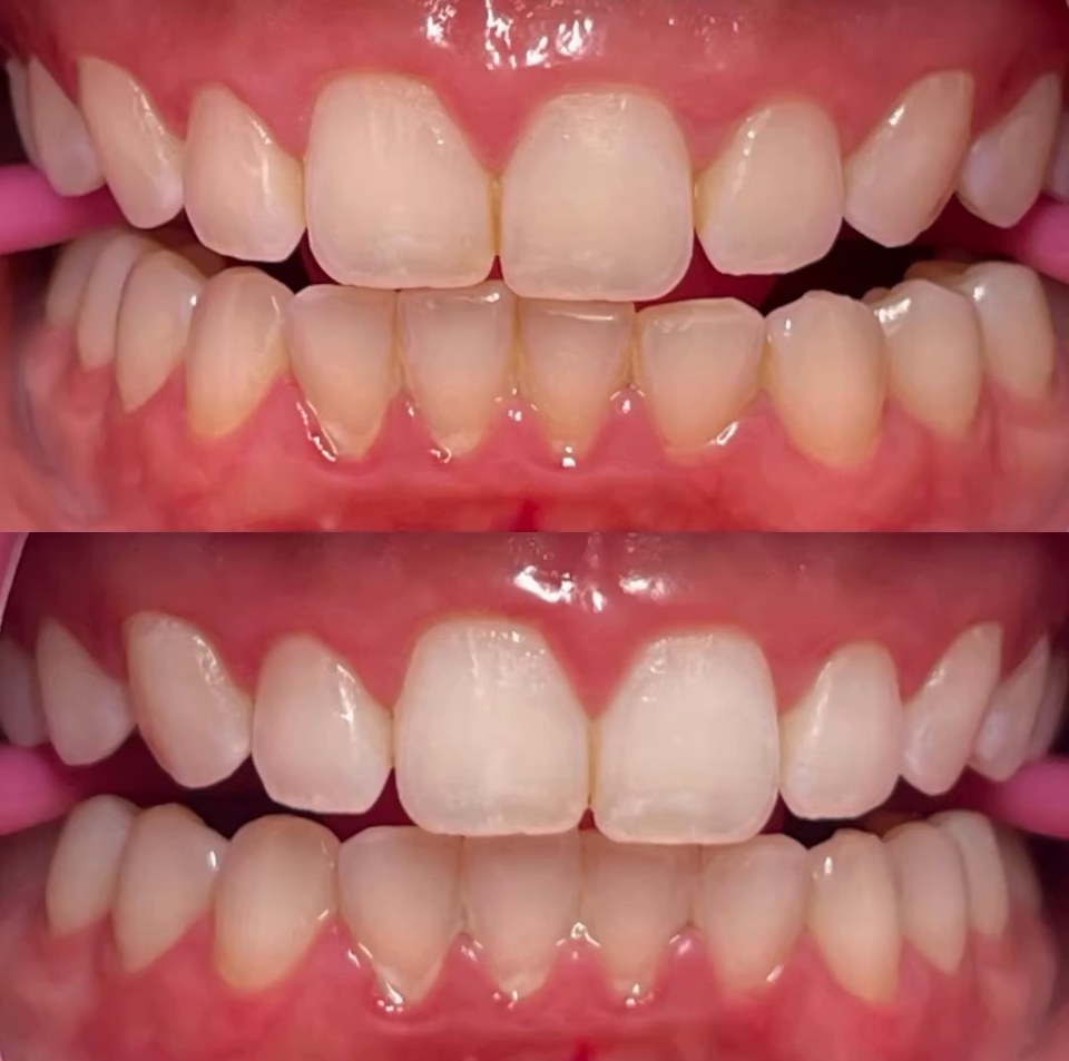 Teeth Whitening 40 Min
