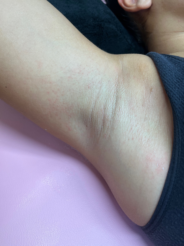 Underarms at Marina Esthetics in Hales Corners, WI