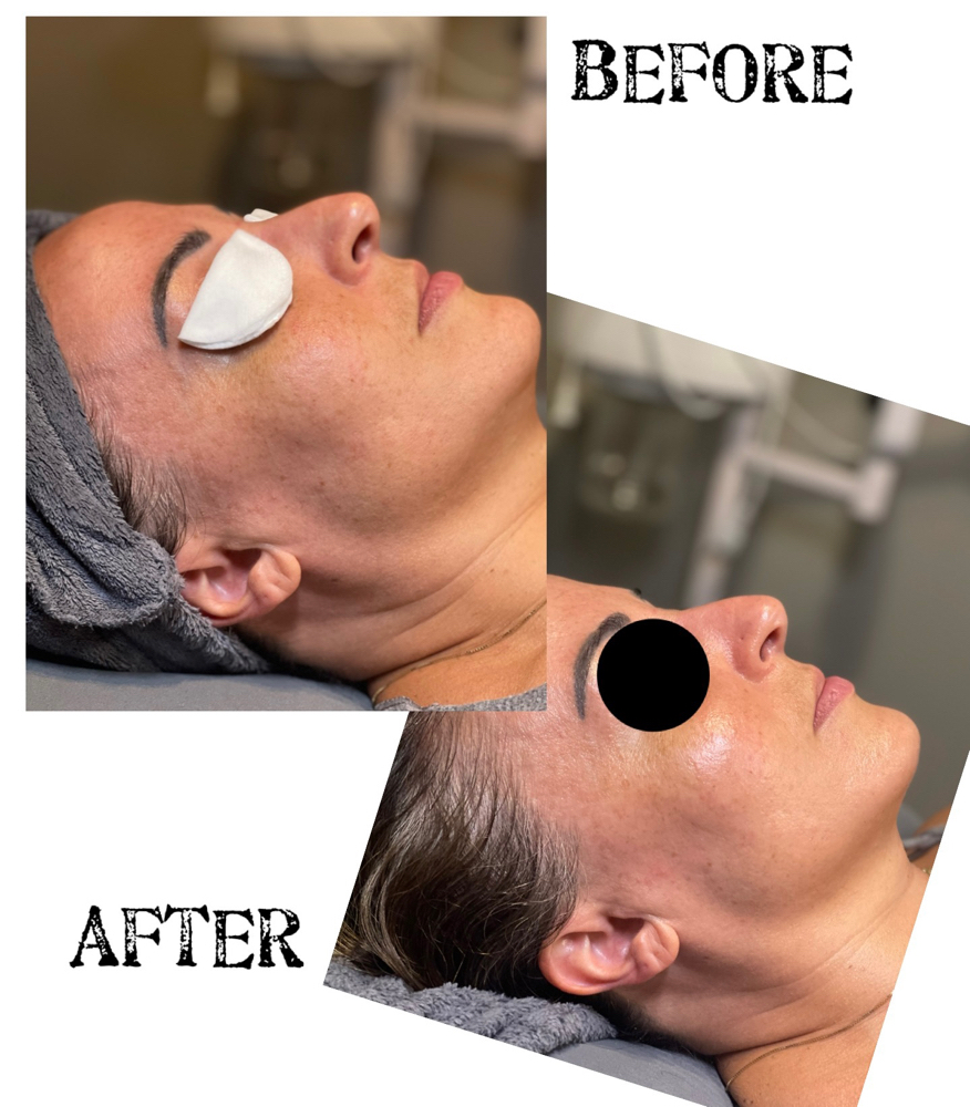 Dermaplane Facial