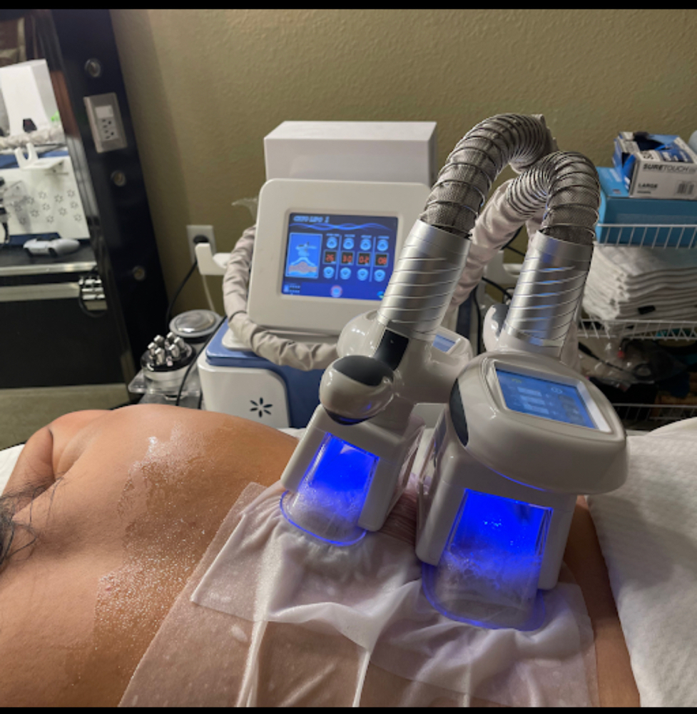 Cryolipolysis