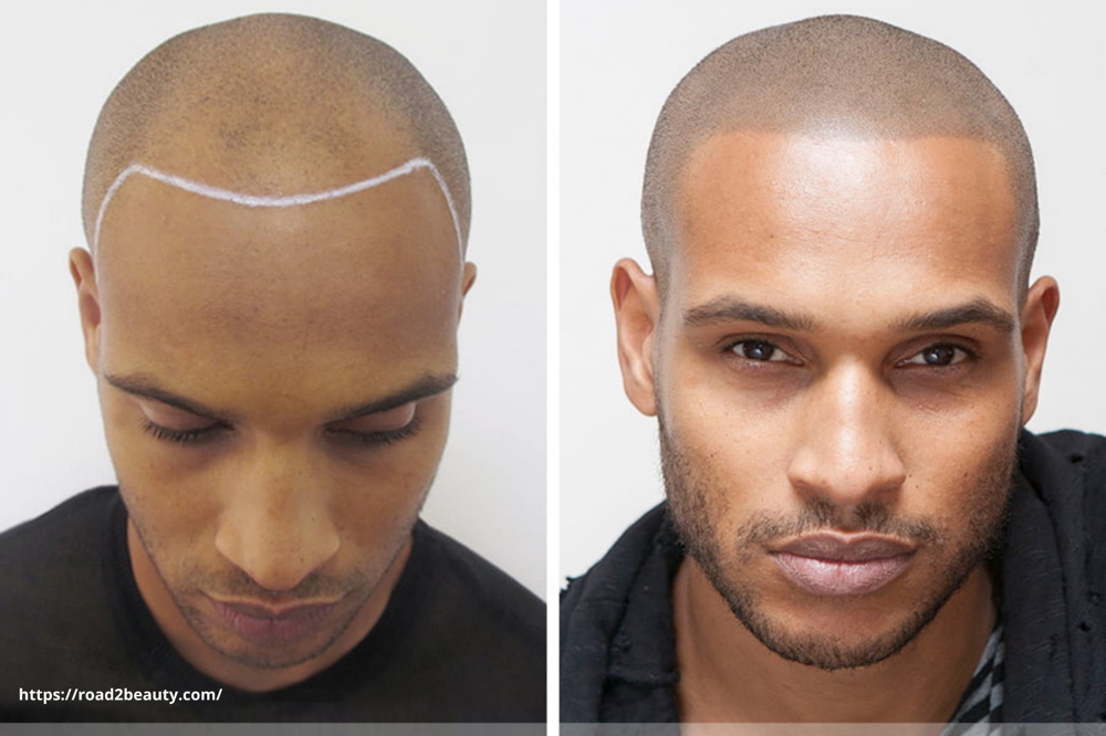 Scalp Micropigmentation
