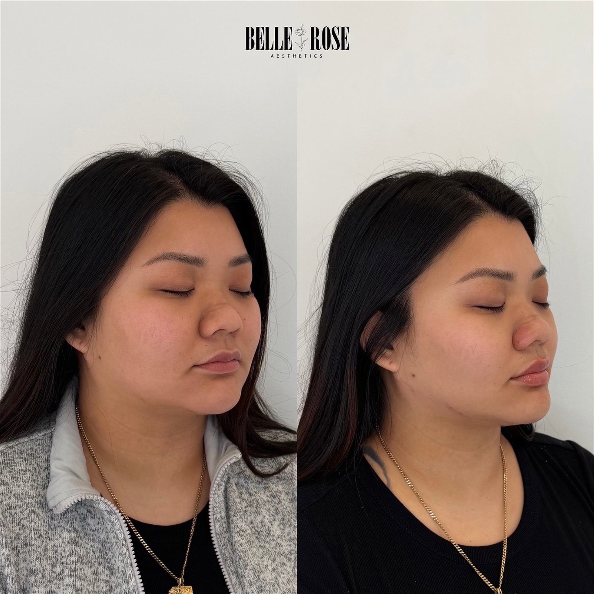JAWLINE CONTOURING WITH FILLER