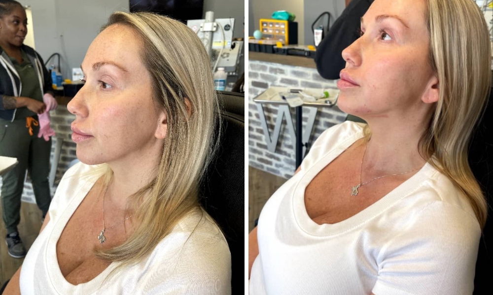 JAWLINE CONTOURING WITH FILLER