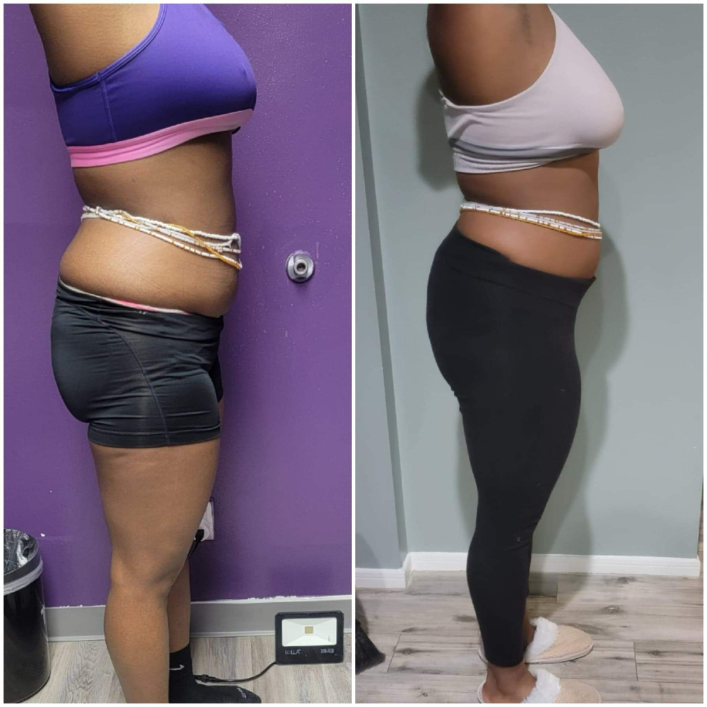 Ultra Sound Cavitation at Glam by Kavivah in Jackson, MS