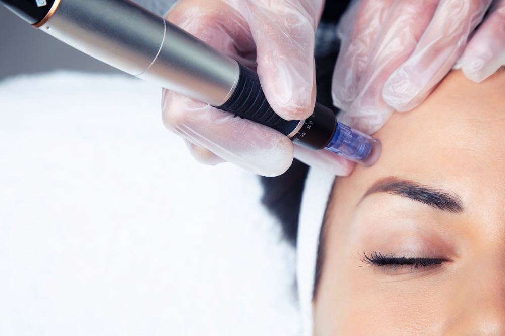 Microneedling