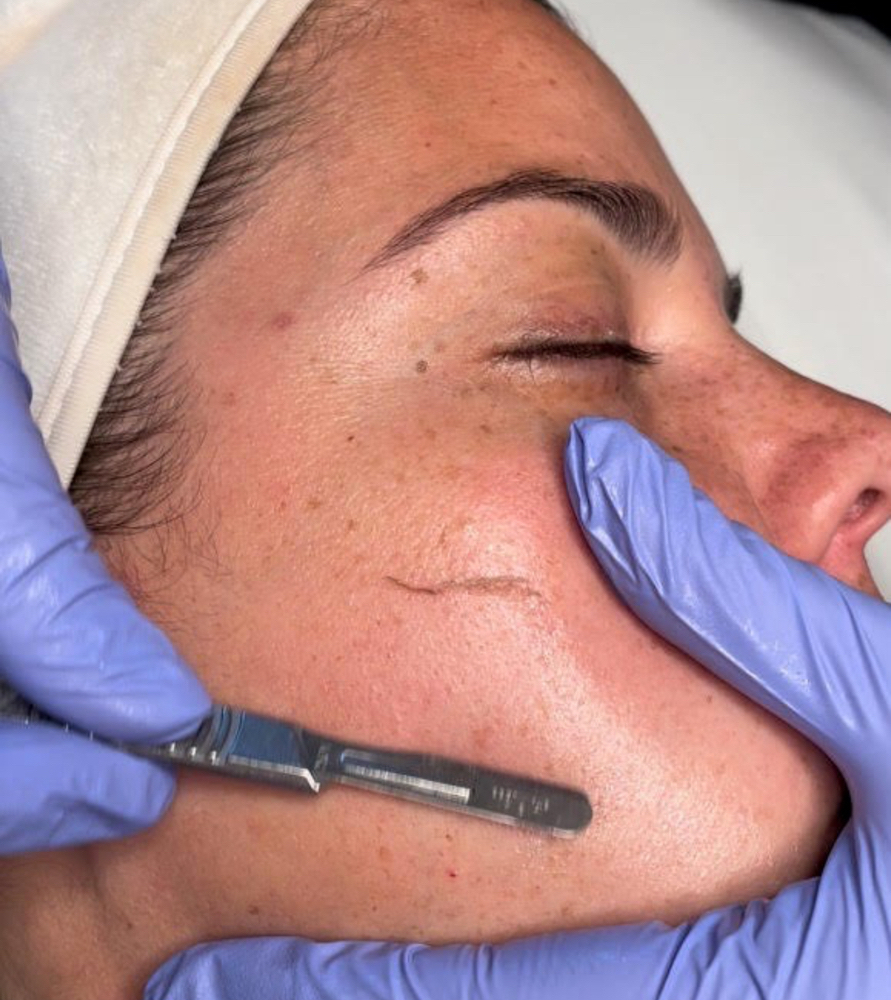 Dermaplane Add On With Facial