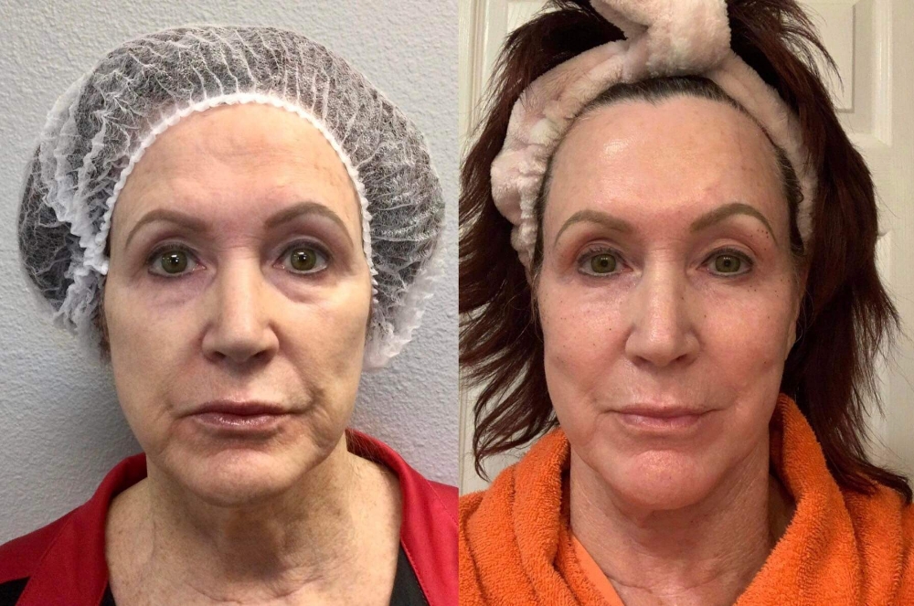 Skin Rejuvenation