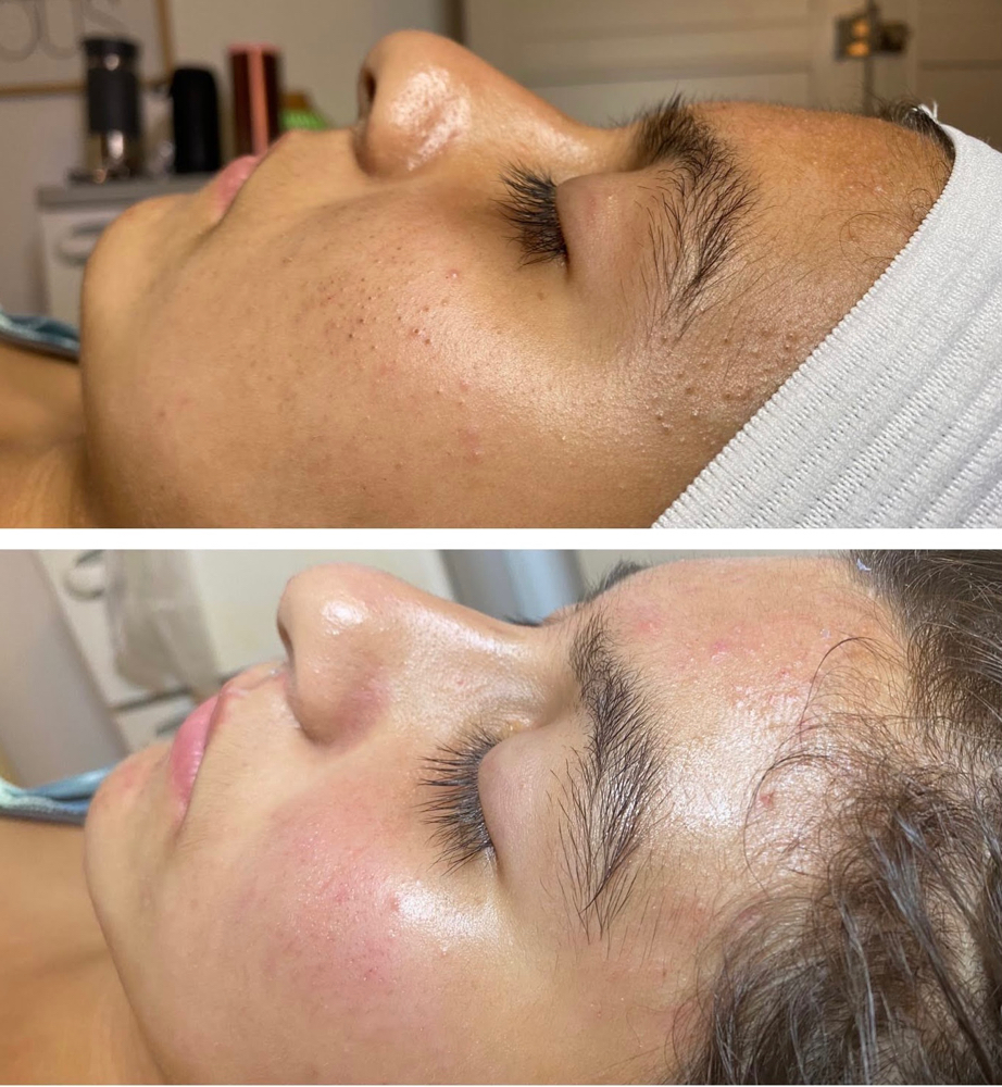 Teen Facial