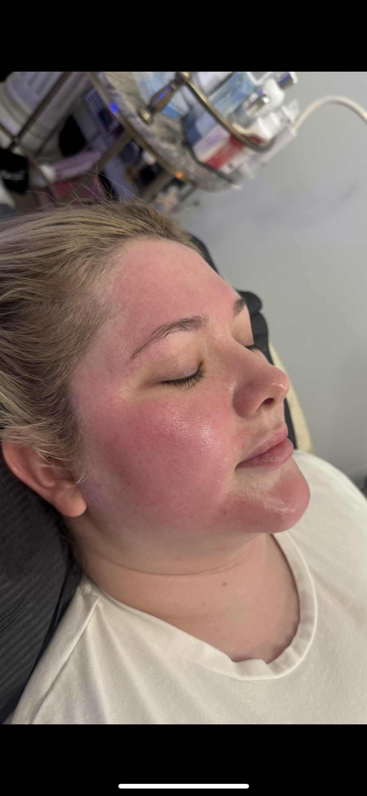 Tri Resurfacing Microneedling