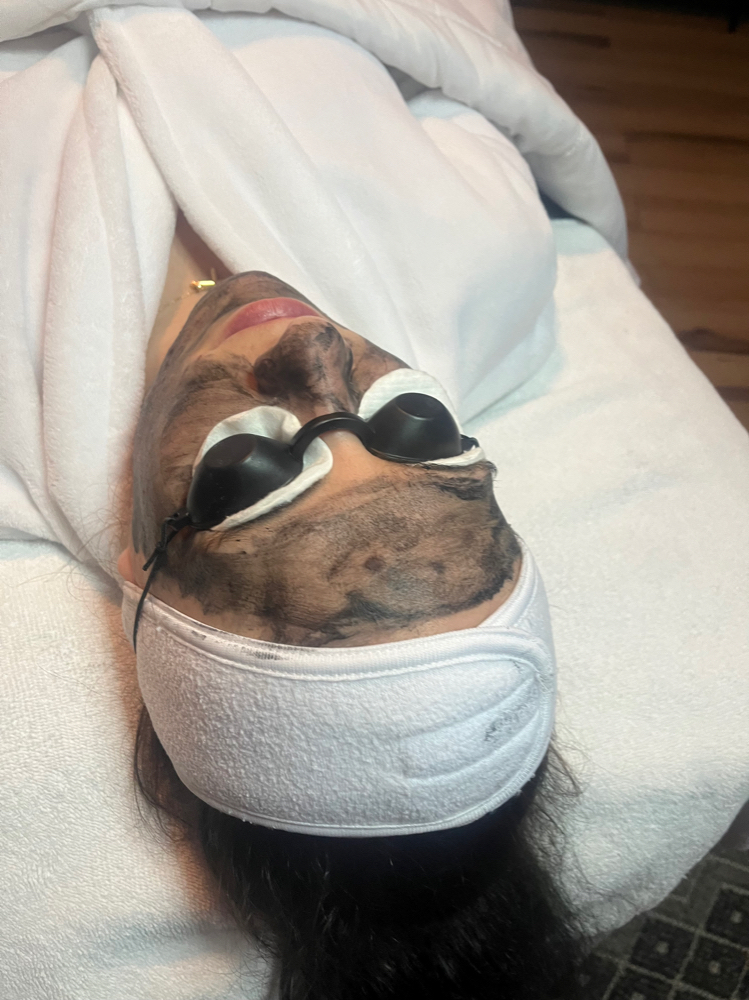 Hollywood Laser Peel Facial