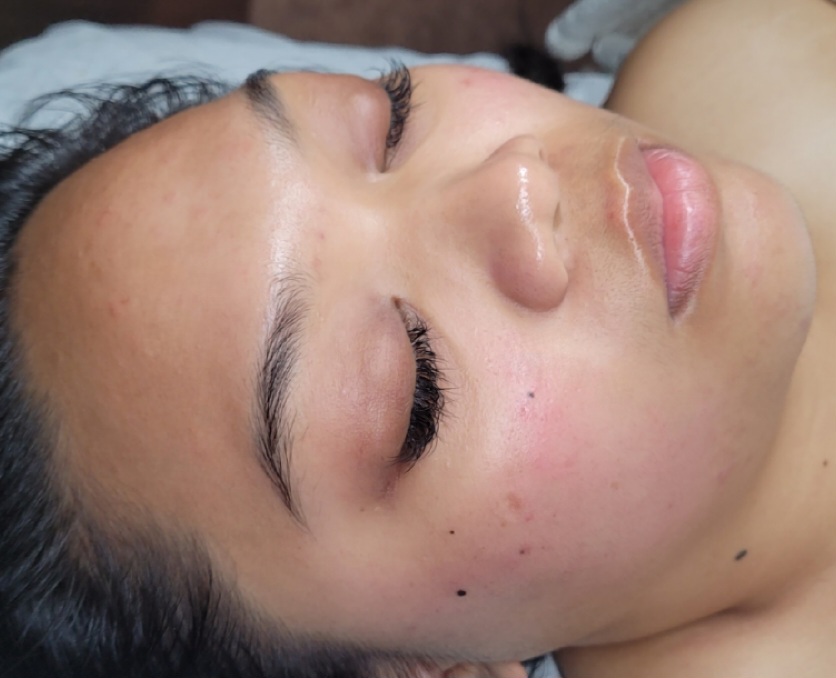 Signature Hydrafacial