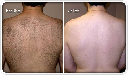 6 x Large Area Laser Hair Removal