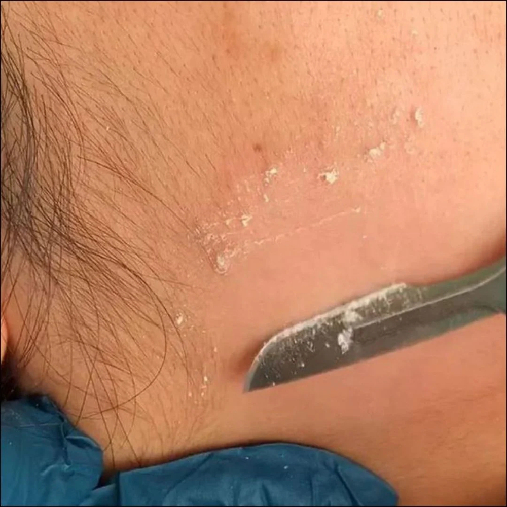 Dermaplaning Facial