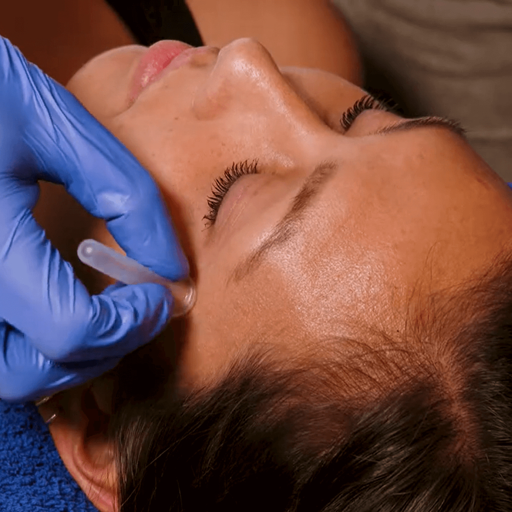 Facial Cupping Therapy