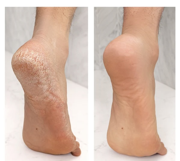 Callus Treatment at Wynn Mobile Care in Denver, CO