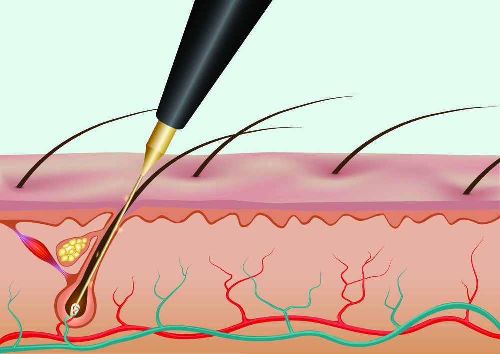 Electrolysis 10 Minutes