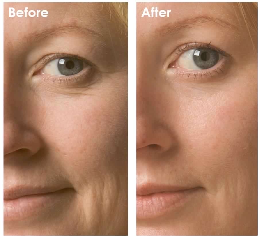 OXYGEN FACIAL