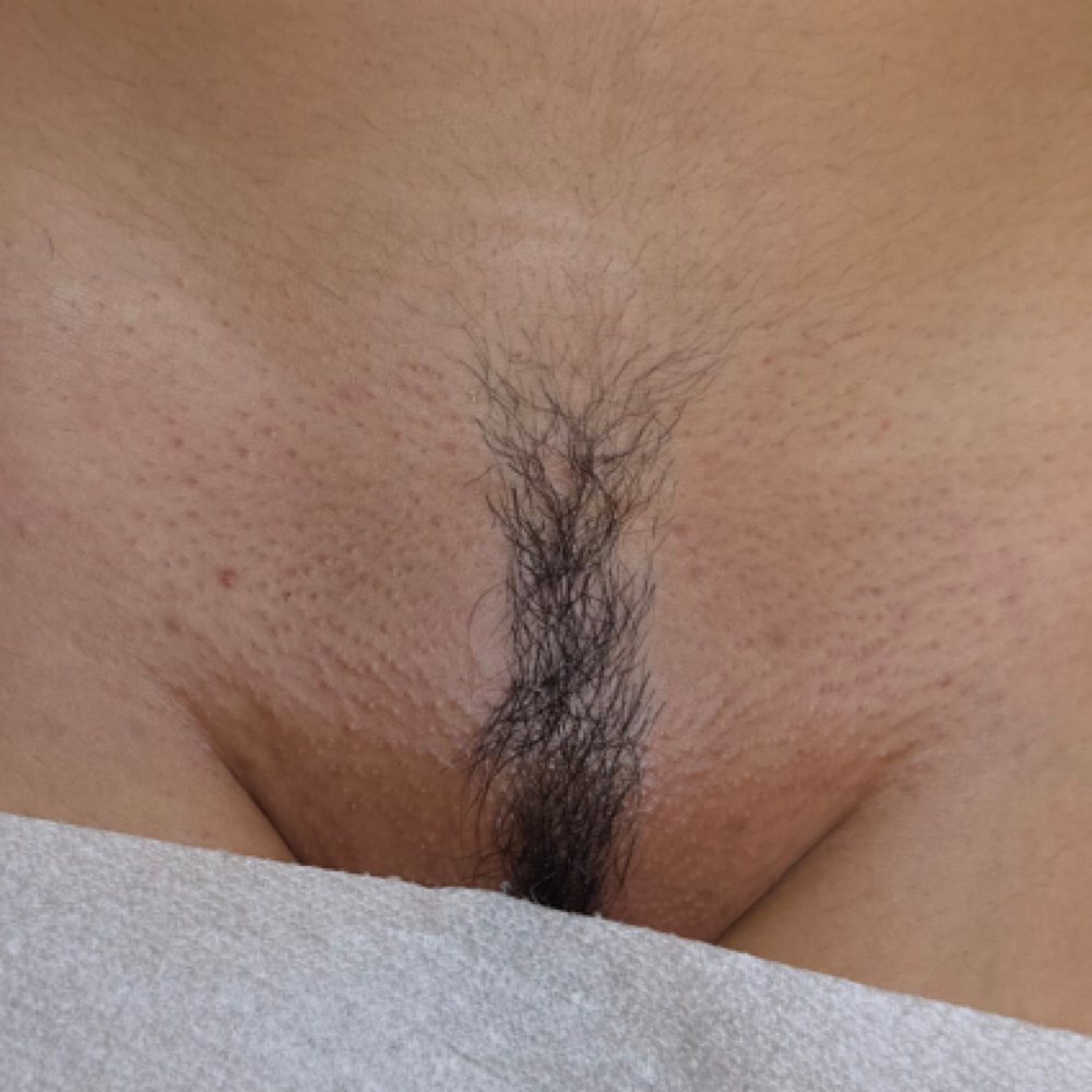 Bikini (Female Anatomy) at CON AMOR ESTHETICS in Los Angeles, CA