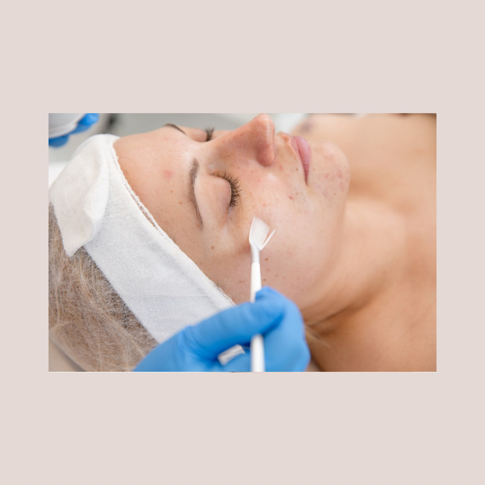 Acne Chemical Peel