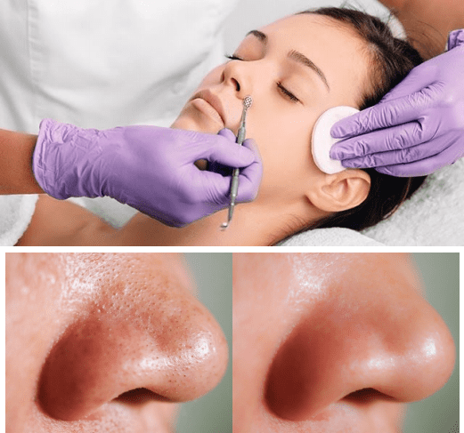 DEEP PORE ACNE CLEANSING