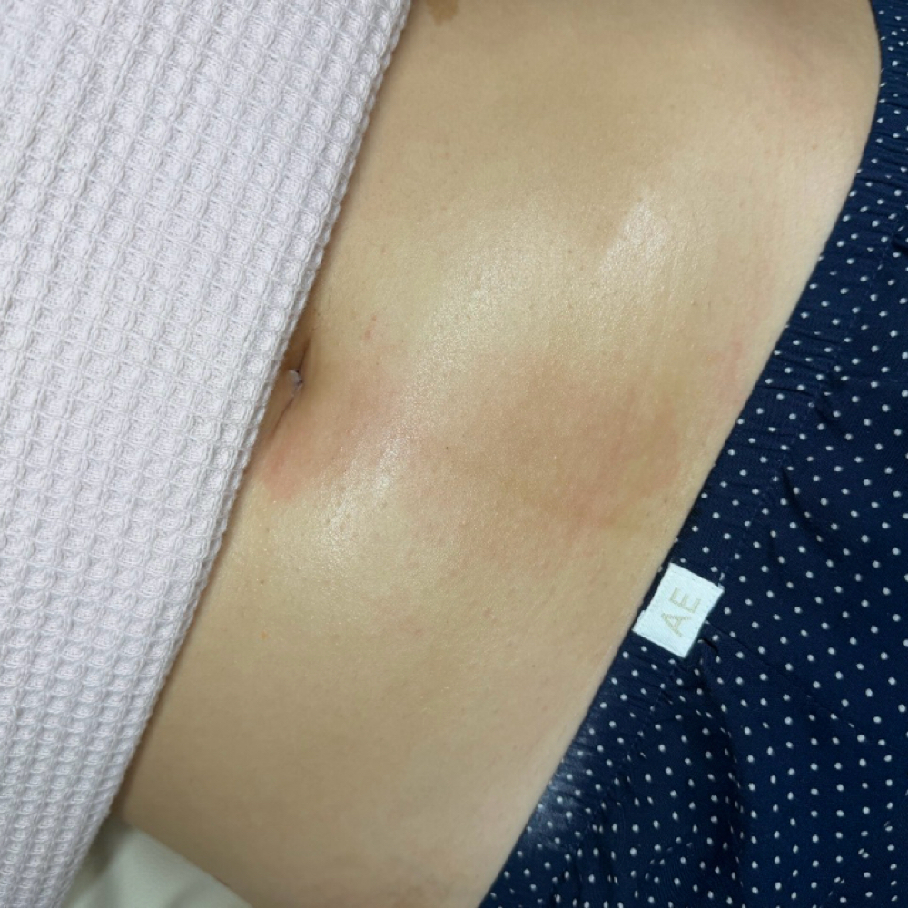 Stomach Strip (Happy Trail) at Elía Esthetics in Woodhaven, NY