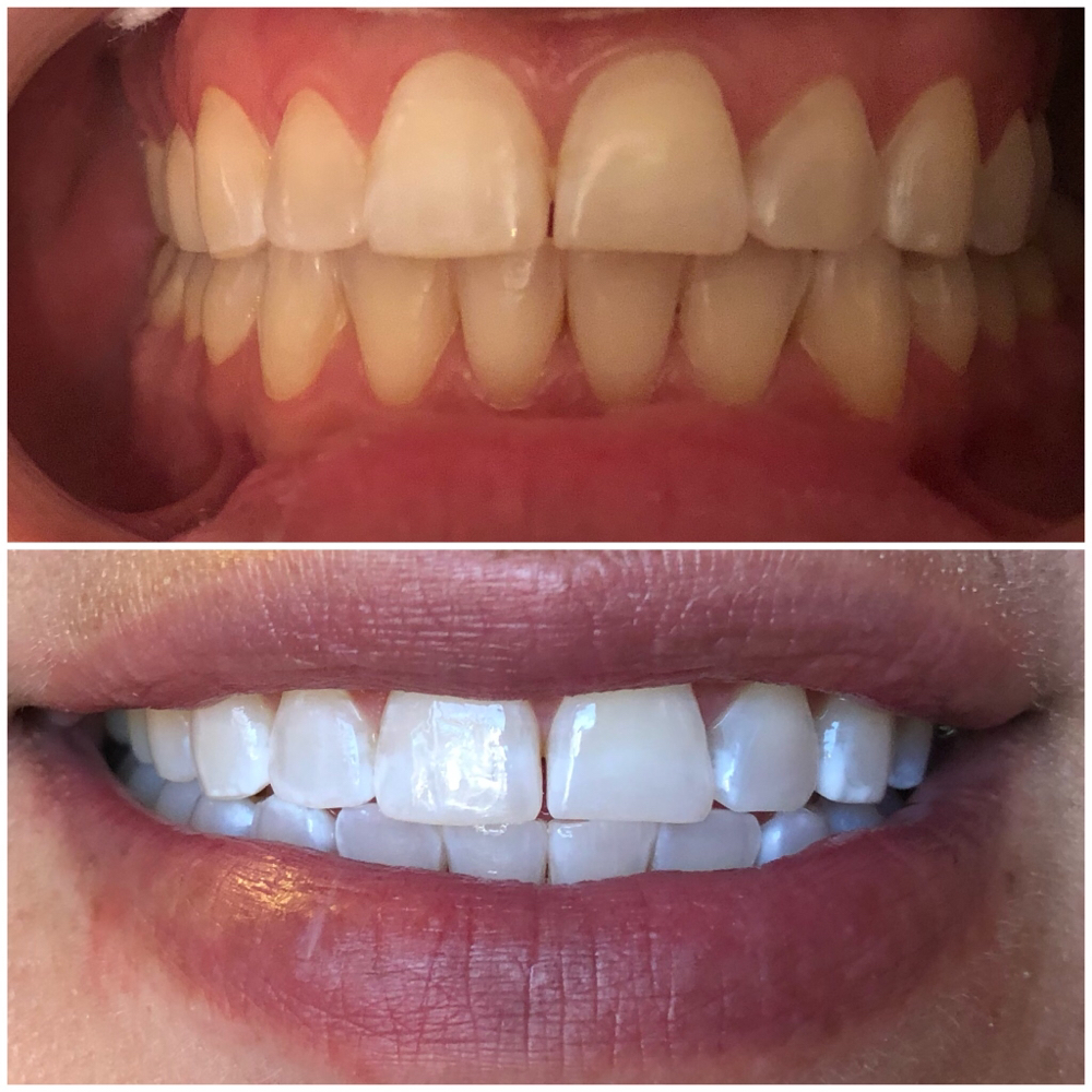 Laser Teeth Whitening