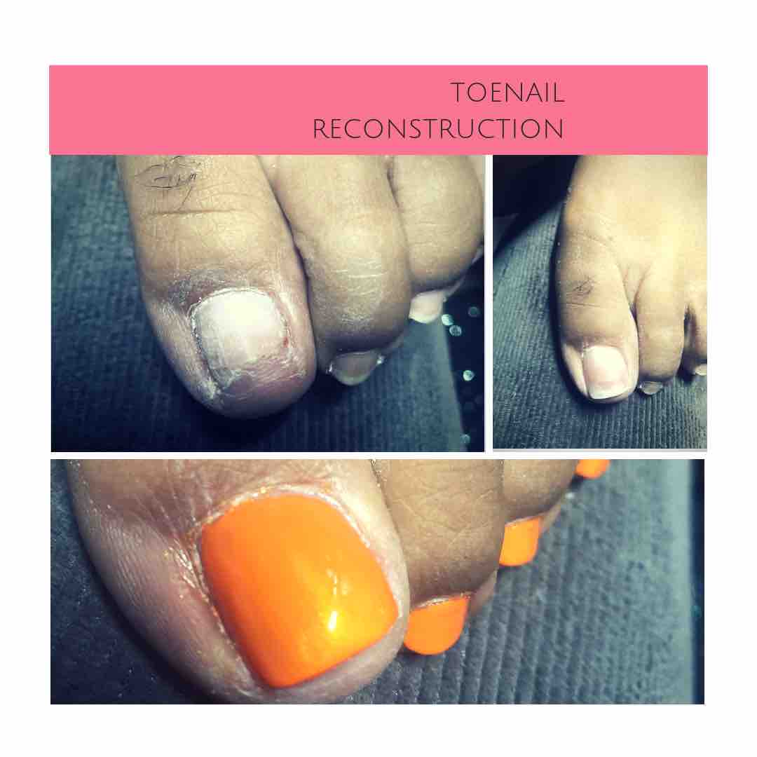 Reconstructed Toe Nail X2