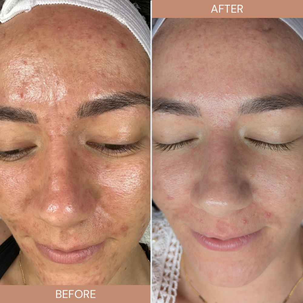 Acne Facial