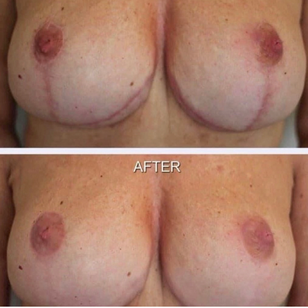 Breast Augmentagion Scar at Mjartistry in Manahawkin, NJ