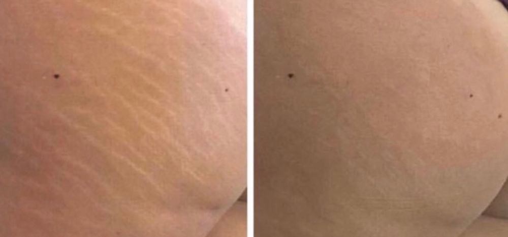 Stretch Marks at Mjartistry in Manahawkin, NJ