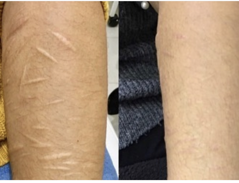 Self Harm Scars at Mjartistry in Manahawkin, NJ