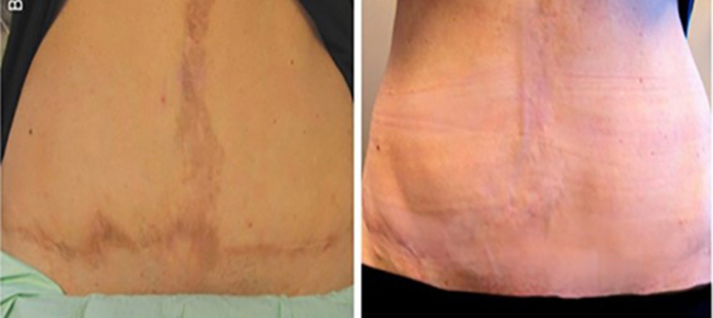 Tummy Tuck Scars at Mjartistry in Manahawkin, NJ