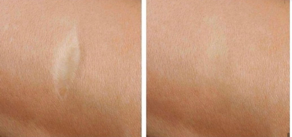 Small Scar at Mjartistry in Manahawkin, NJ