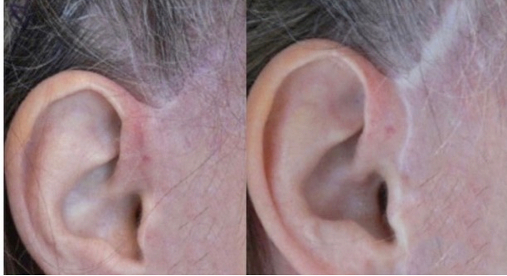 Face Lift Scar at Mjartistry in Manahawkin, NJ