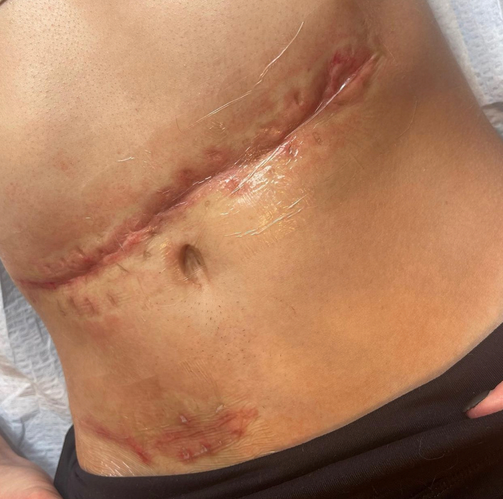 Skin Needling at Mjartistry in Manahawkin, NJ