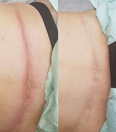 Inkless Scar Revision