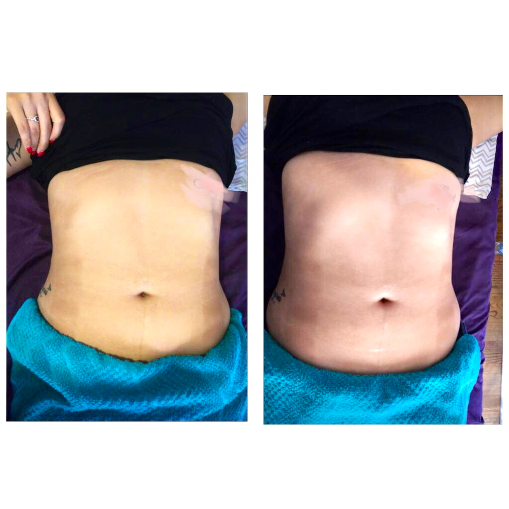 2nd Round Lipo Cavitation