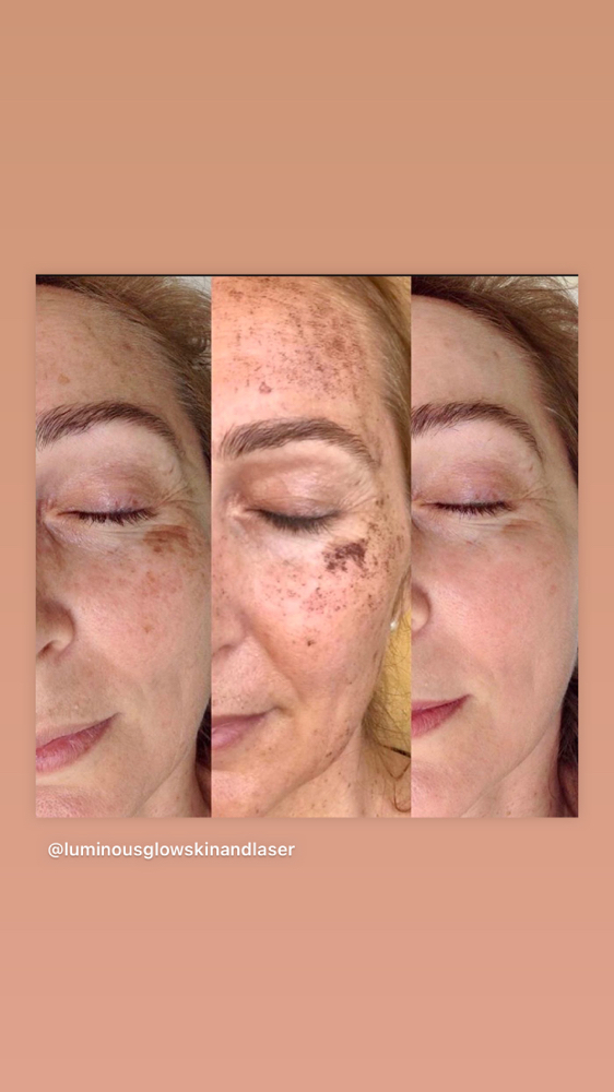 IPL FACE PIGMENTATION REMOVAL