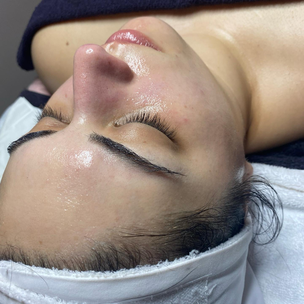 Carboxy Therapy Facial