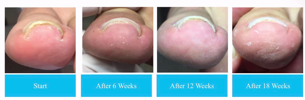 Painless Toenail Correction