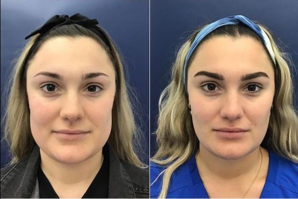 Teeth Grinding & Jaw Tapering