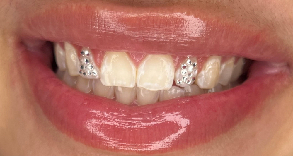 ‘Iced out’ Tooth Gem Set