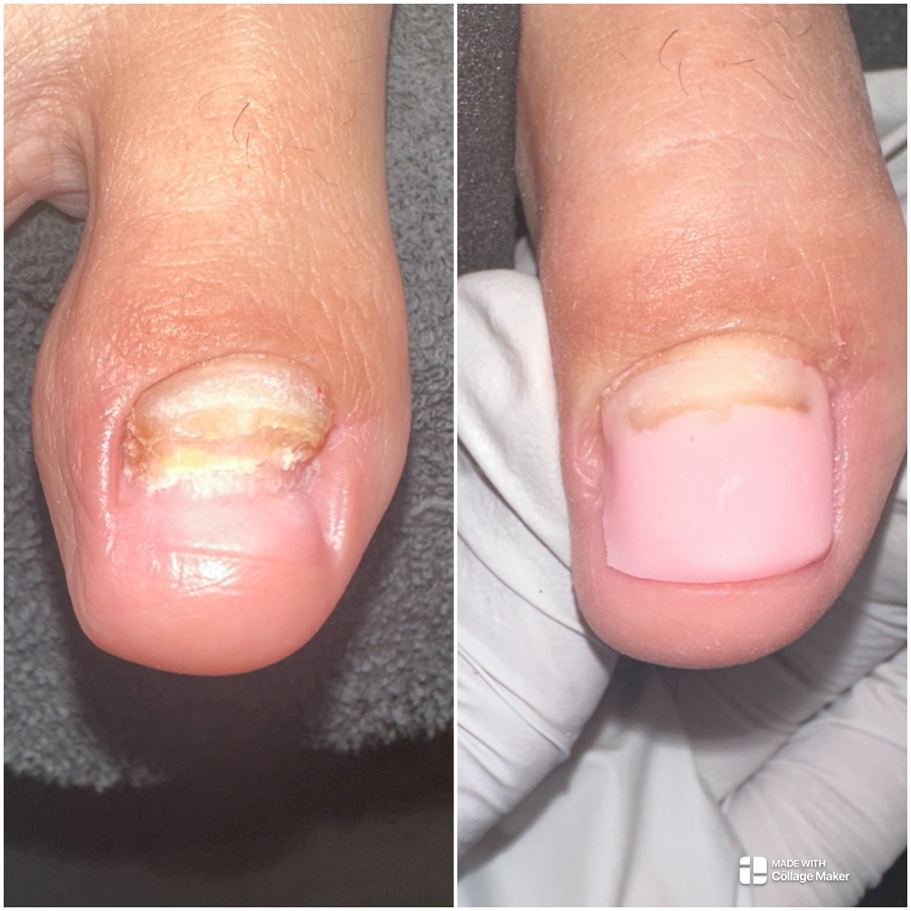 Toe Nail Reconstruction