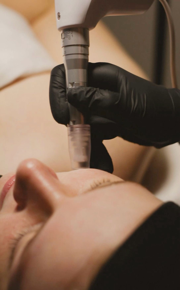 MicrodermabrasioN FaciaL