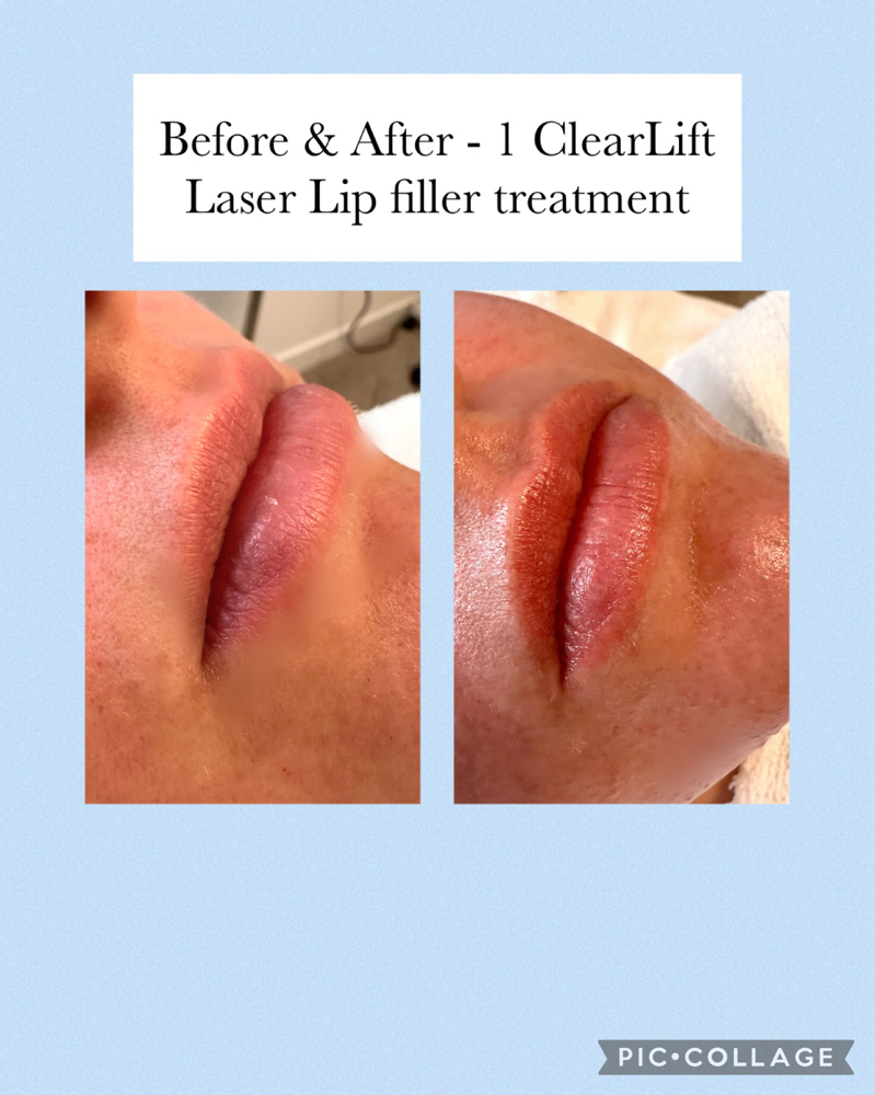 ClearLift™ Laser Lip Plumping