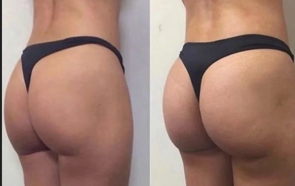 Brazilian Butt Vacuum Therapy