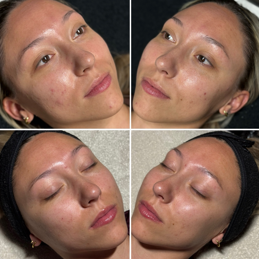 Acne Consult at Taylor’d To You - AWE Skin Studio in Lebanon, TN