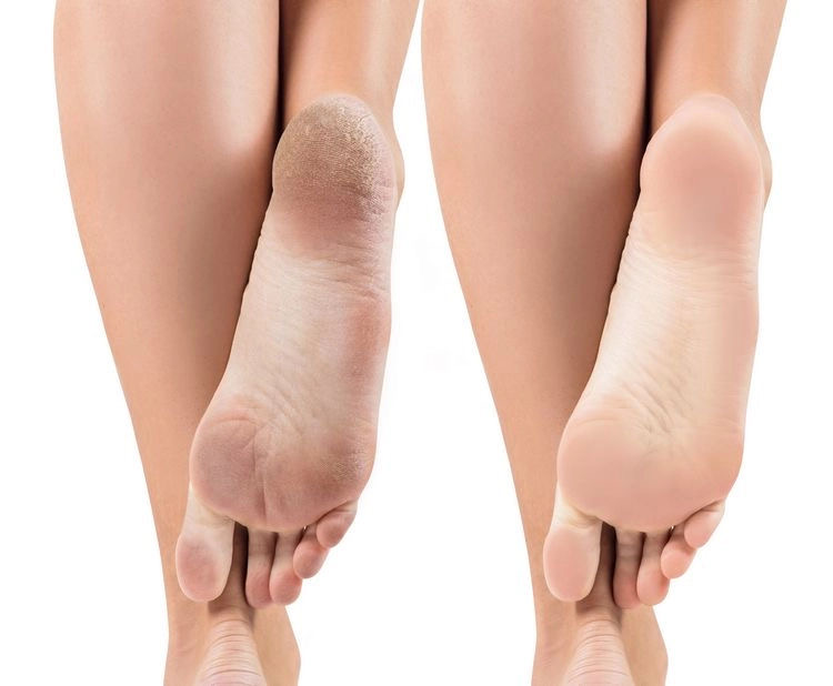 Callus Removal