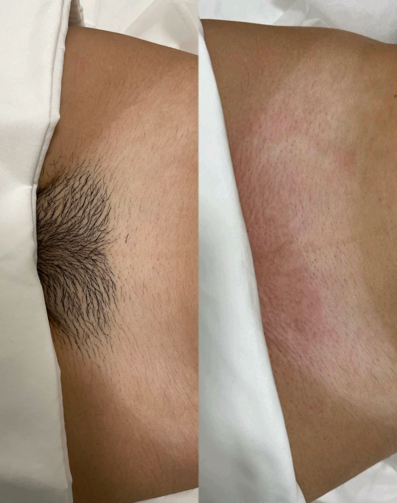 Brazilian Wax